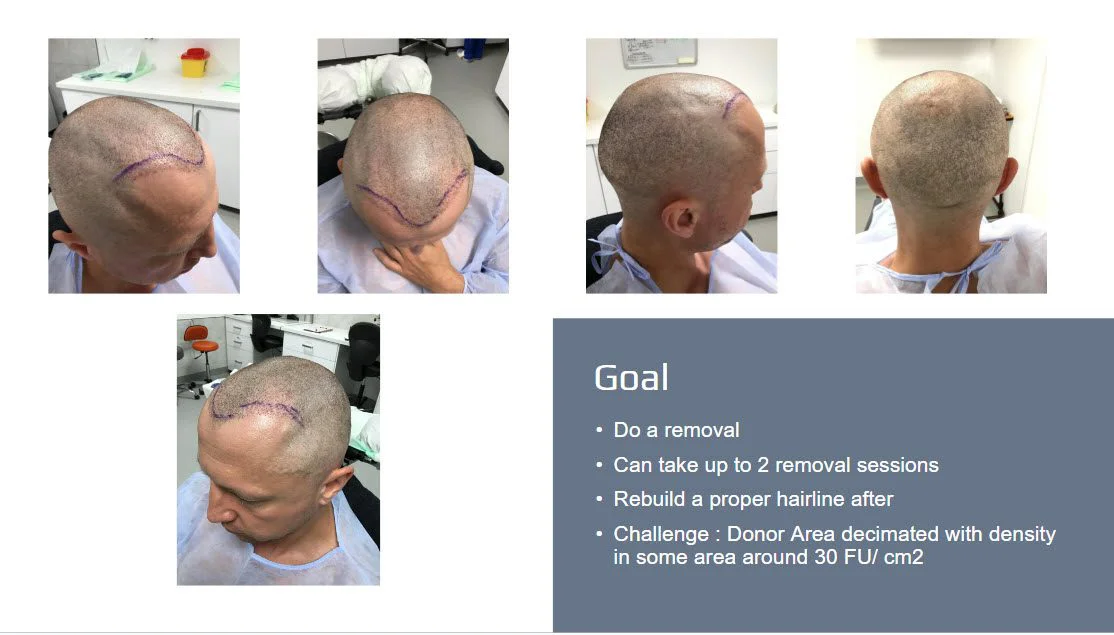 การแก้ไขการปลูกถ่ายผม